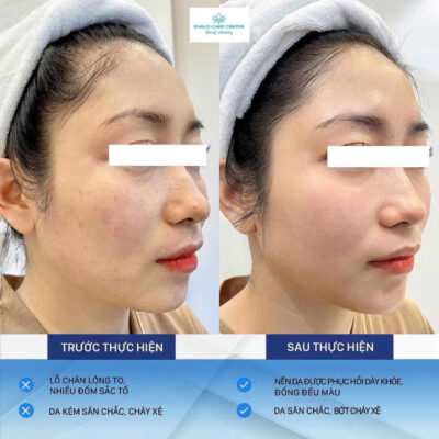 ✨ BÍ QUYẾT TRẺ HÓA LÀN DA – GIỮ MÃI THANH XUÂN CHO PHÁI ĐẸP ✨ 🌸 Trẻ hóa da – Giải pháp “cứu cánh” cho làn da đang mỏi mệt! Tại #Ehalo, chúng tôi mang đến công nghệ trẻ hóa hiện đại: ✅ Kích thích collagen tái sinh – giúp da căng mịn, săn chắc ✅ Xóa mờ nếp nhăn – làm đầy rãnh cười ✅ Se khít lỗ chân lông – cải thiện độ đàn hồi ✅ Làn da sáng hồng, đều màu như thuở đôi mươi 🔥 Chỉ sau 1 liệu trình, bạn sẽ cảm nhận sự khác biệt rõ rệt: -Da sáng khỏe, căng bóng tự nhiên -Gương mặt trẻ trung, rạng rỡ hơn từ 5–7 tuổi -Không cần phẫu thuật – Không đau – Không nghỉ dưỡng ---------------------------------------------------- EHALO CARE CENTER - Liệu pháp trẻ hoá tế bào toàn diện