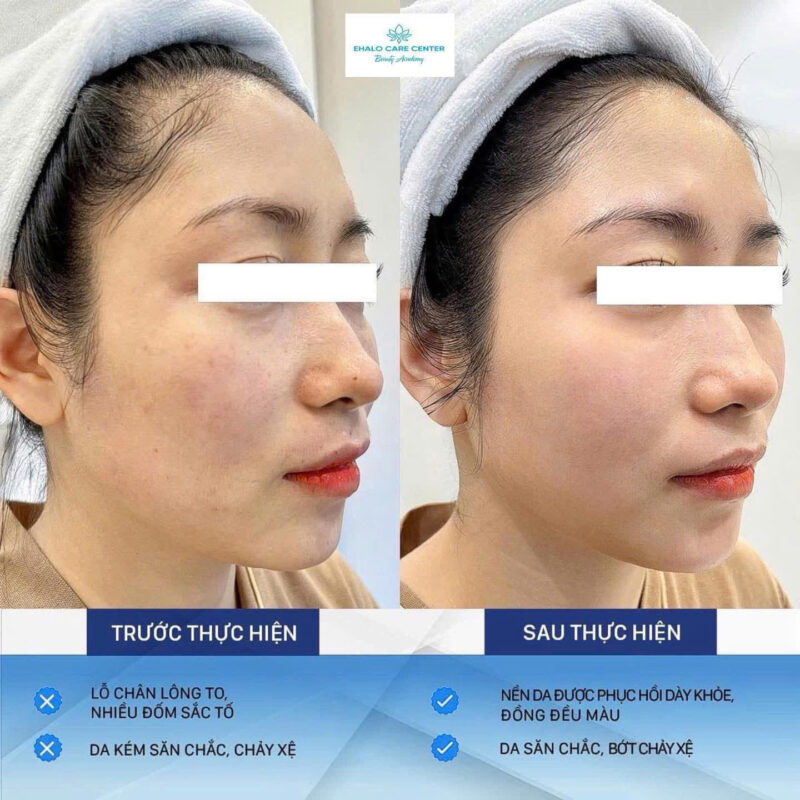 ✨ BÍ QUYẾT TRẺ HÓA LÀN DA – GIỮ MÃI THANH XUÂN CHO PHÁI ĐẸP ✨ 🌸 Trẻ hóa da – Giải pháp “cứu cánh” cho làn da đang mỏi mệt! Tại #Ehalo, chúng tôi mang đến công nghệ trẻ hóa hiện đại: ✅ Kích thích collagen tái sinh – giúp da căng mịn, săn chắc ✅ Xóa mờ nếp nhăn – làm đầy rãnh cười ✅ Se khít lỗ chân lông – cải thiện độ đàn hồi ✅ Làn da sáng hồng, đều màu như thuở đôi mươi 🔥 Chỉ sau 1 liệu trình, bạn sẽ cảm nhận sự khác biệt rõ rệt: -Da sáng khỏe, căng bóng tự nhiên -Gương mặt trẻ trung, rạng rỡ hơn từ 5–7 tuổi -Không cần phẫu thuật – Không đau – Không nghỉ dưỡng ---------------------------------------------------- EHALO CARE CENTER - Liệu pháp trẻ hoá tế bào toàn diện